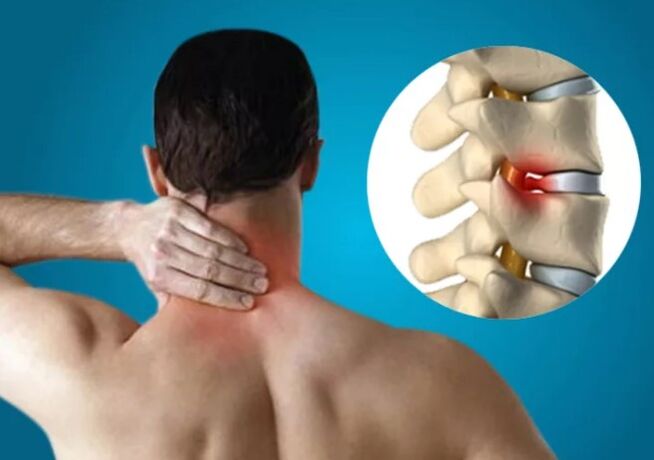 Gimdos kaklelio osteochondrozė