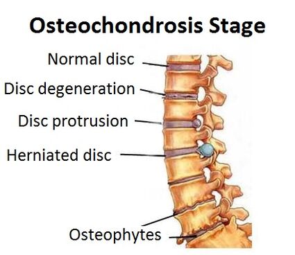 Osteochondrozės etapai