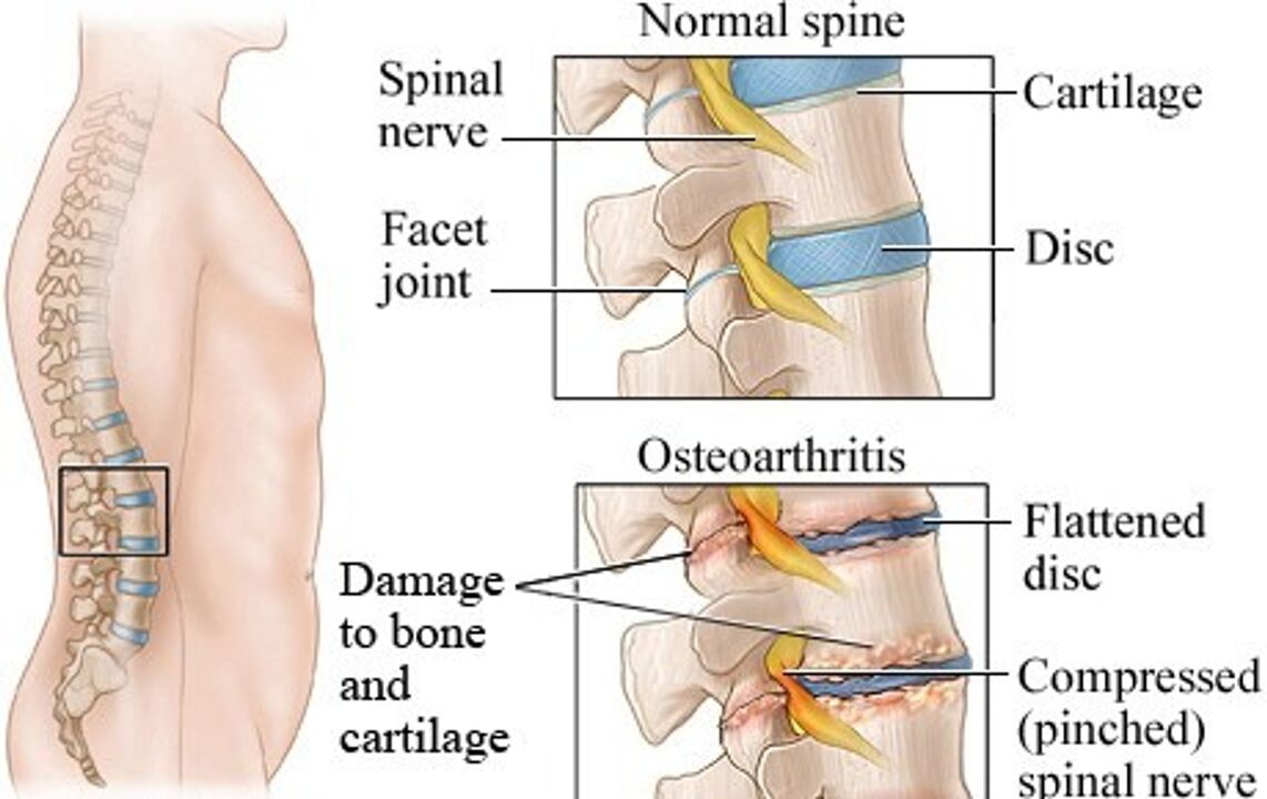 Skirtumas tarp sveiko disko ir disko su osteochondroze